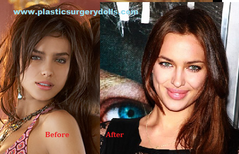 irina-shayk-plastic-surgery